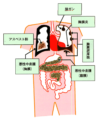 アスベストがおこす健康障害