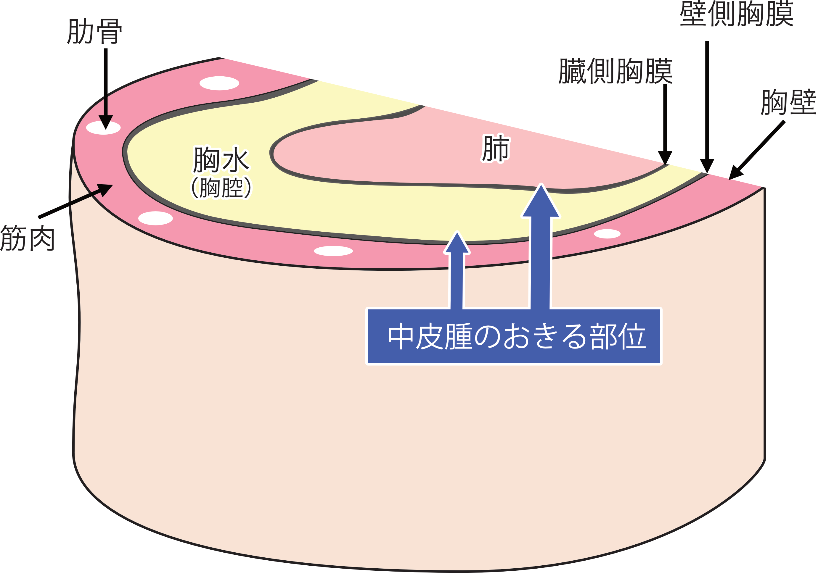 中皮腫とは　部位について