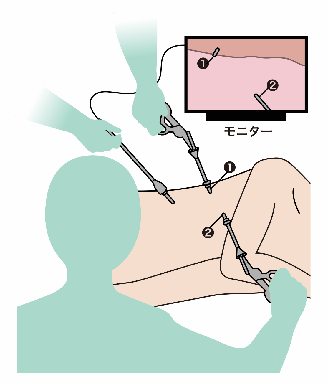 胸腔鏡検査