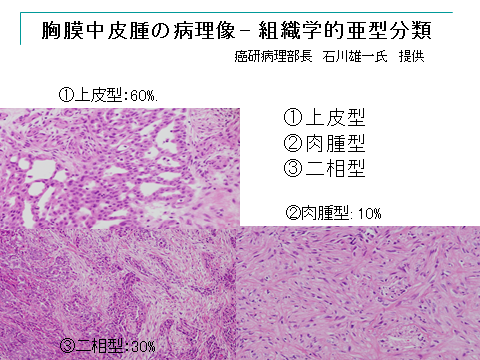 胸膜中皮腫の病理について