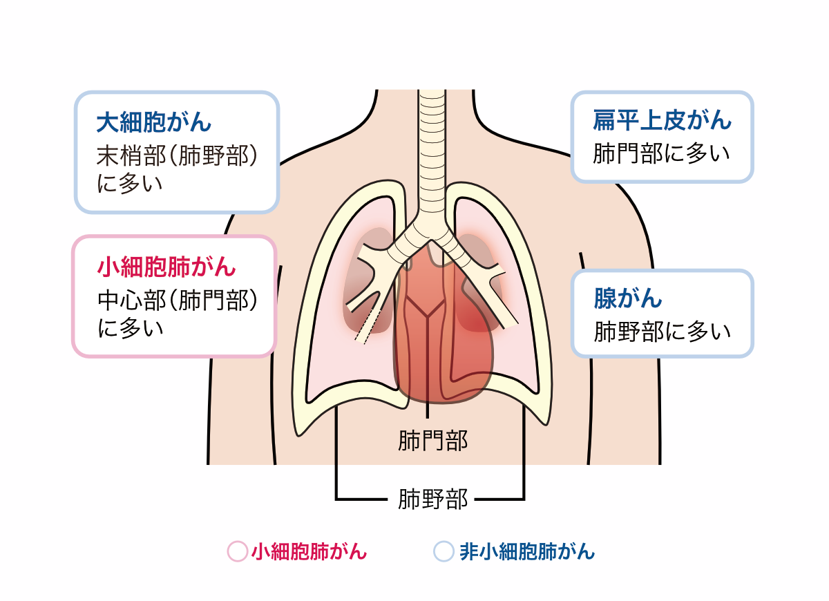 肺がんの種類と発生しやすい場所