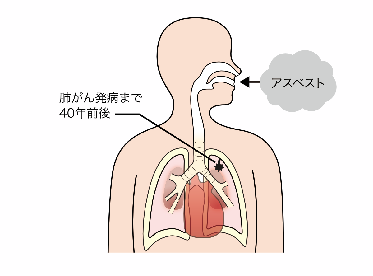 肺がん発病まで