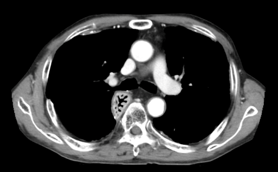 肺のCT画像
