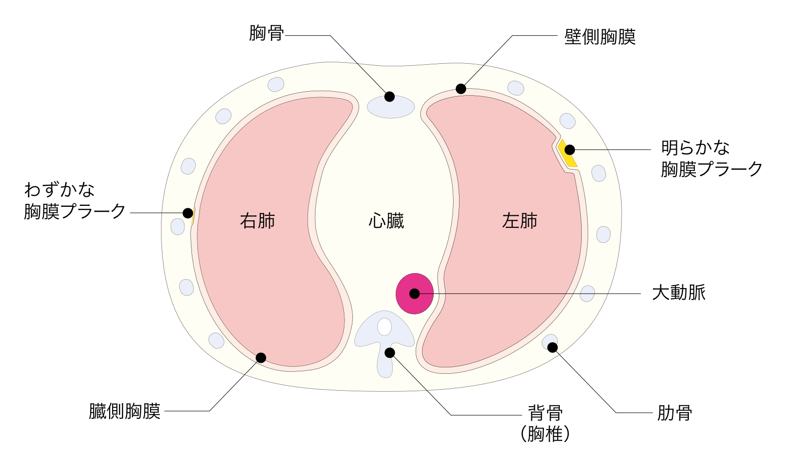 胸膜プラーク 胸膜肥厚斑 台形状 典型的 わずかな胸膜プラーク