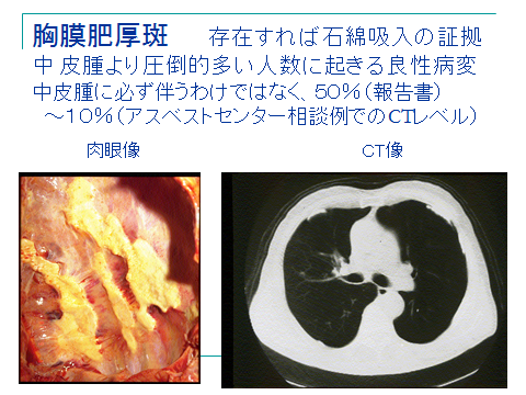 石綿関連疾患とは