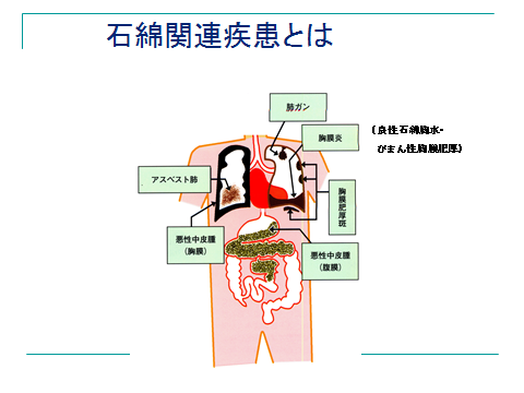 石綿関連疾患とは