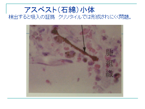 石綿関連疾患とは